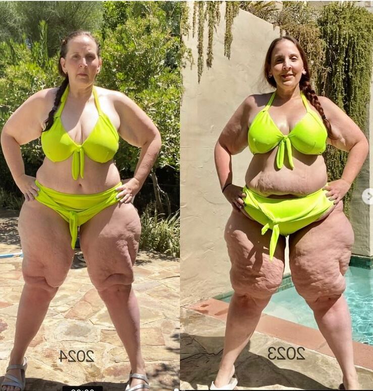 Pernas de celulite de verão