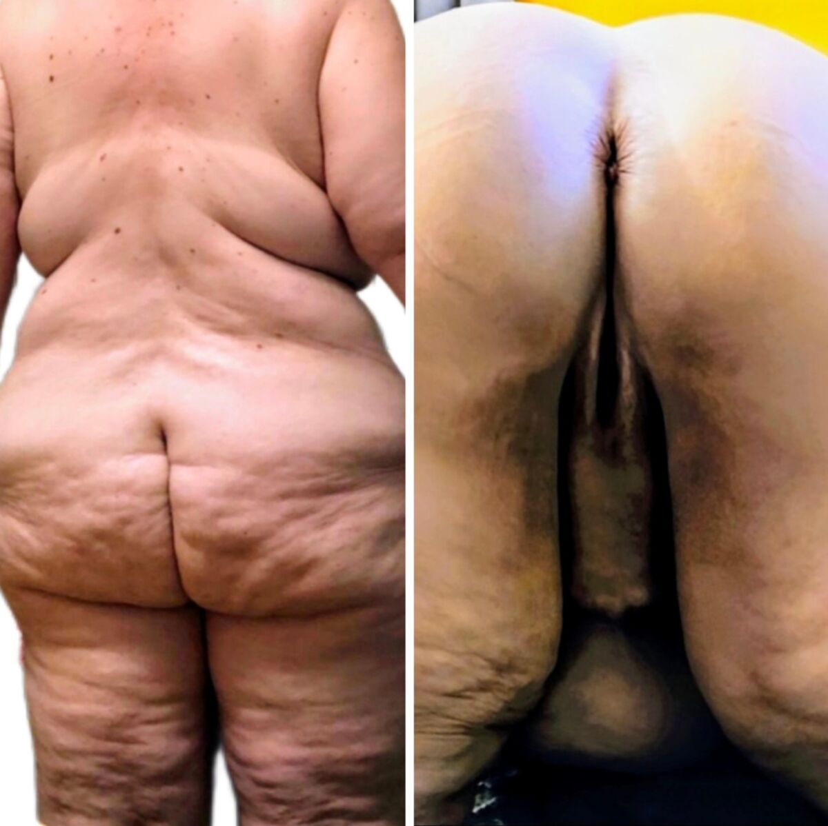 Lindas bebês de celulite